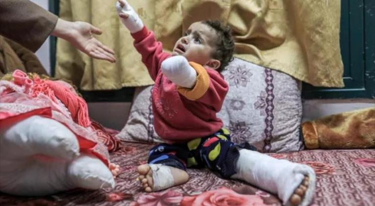 Amputaciones pediátricas en Gaza baten récord en la historia