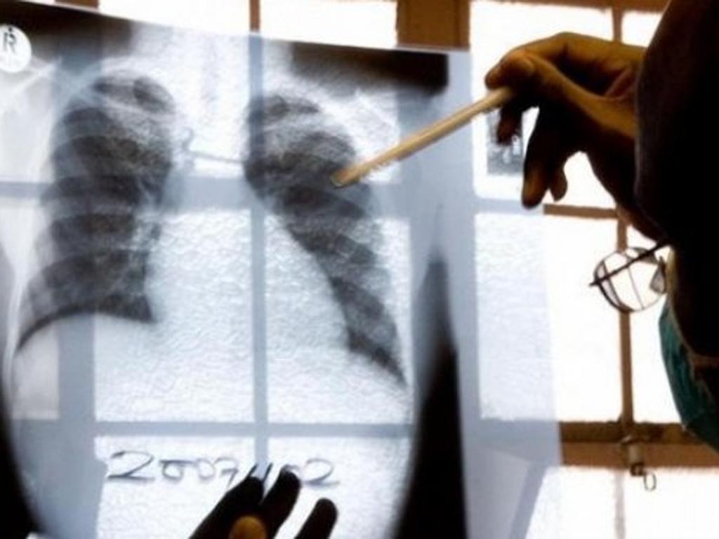 Sí se puede poner fin a la tuberculosis, alerta en su Día Mundial. Foto: Prensa Latina